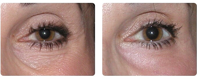 Under Eye Wrinkles Fillers in Glasgow | Westerwood Health Clinic