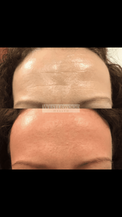smooth forehead lines Westerwood Health Clinic