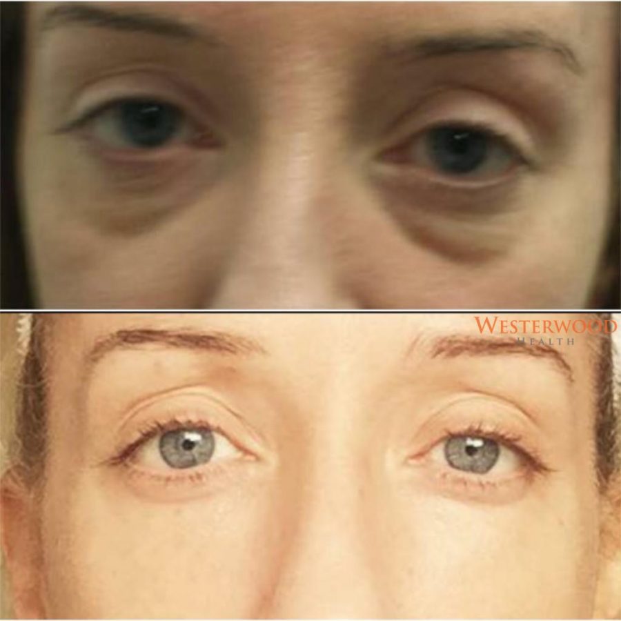eye bag lift Westerwood Health Clinic